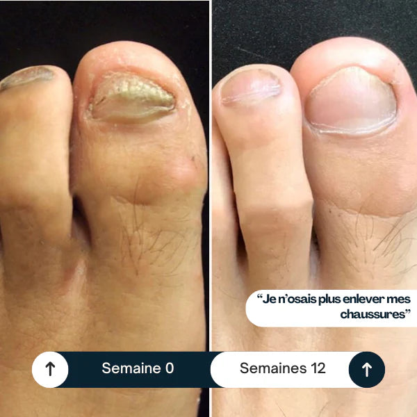 Stylo antifongique - 25% d'acide undécylénique