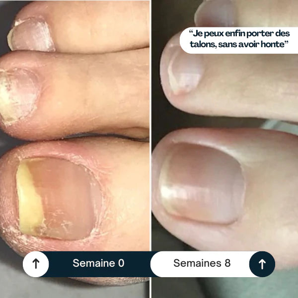 Stylo antifongique - 25% d'acide undécylénique